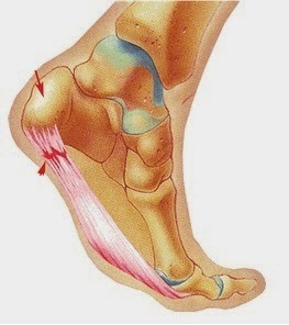 Plantar Fasciitis: Causes, Symptoms, and Treatments