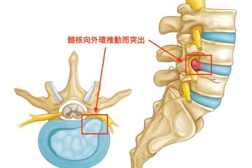 椎間盤突出
