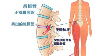 腰痛扯落腳？腳麻腳痺反覆出現？